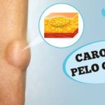 Caroços pelo corpo e lipoma: O que são? O que reparar?