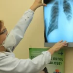 TUBERCULOSE: Coordenadora do Ministério da Saúde tira dúvidas sobre doença
