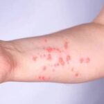 Mpox: Brasil registra 140 casos em 2026